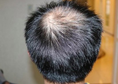 专业头发种植医院都有那些