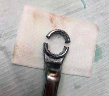 男子某处被扳手套住17小时是怎么回事?