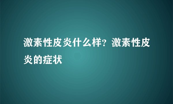 激素性皮炎什么样？激素性皮炎的症状
