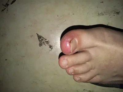 蝎蜇伤症状图片