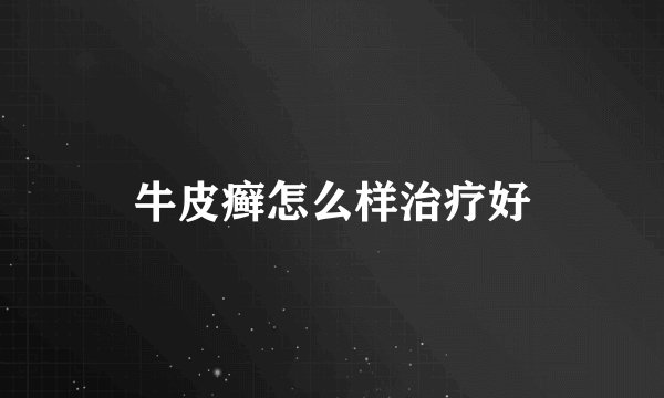 牛皮癣怎么样治疗好