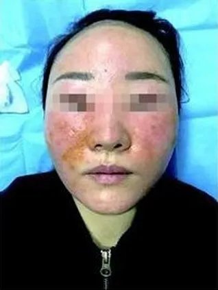 花3万美容变毁容是怎么回事?