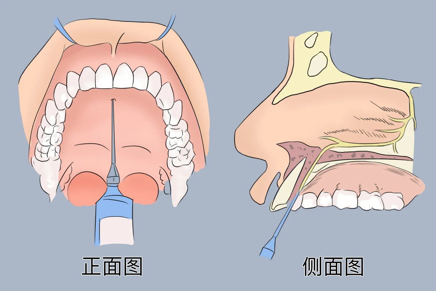 拔牙打麻药位置图解
