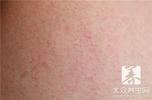 皮炎平治疗湿疹好吗