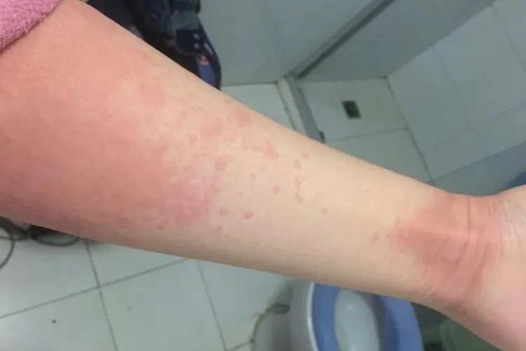 手臂过敏图片