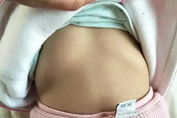 鸡胸症状图片