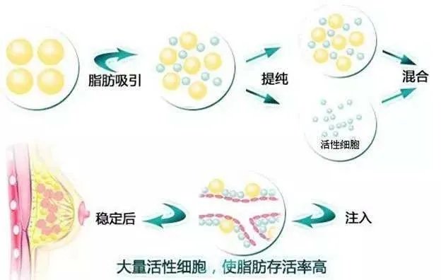 做自体脂肪隆胸效果怎么样？