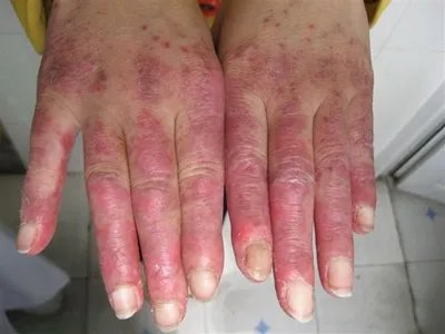 系统性红斑狼疮红斑图片