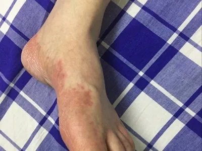 系统性红斑狼疮红斑图片