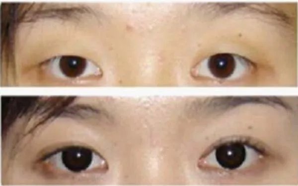 北京埋线双眼皮整形哪个医院好？