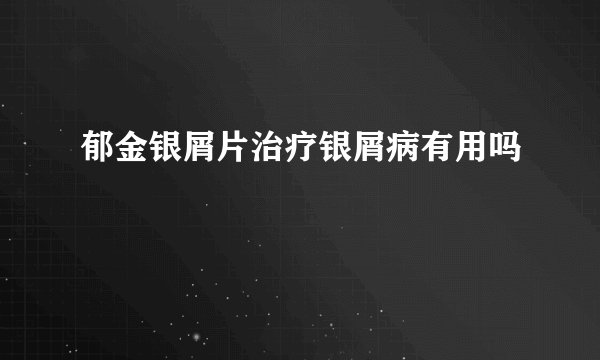 郁金银屑片治疗银屑病有用吗