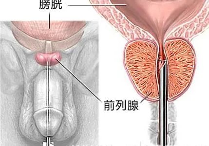 鸡鸡有点刺痛感是什么原因?