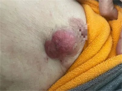 乳腺癌乳房硬块图片