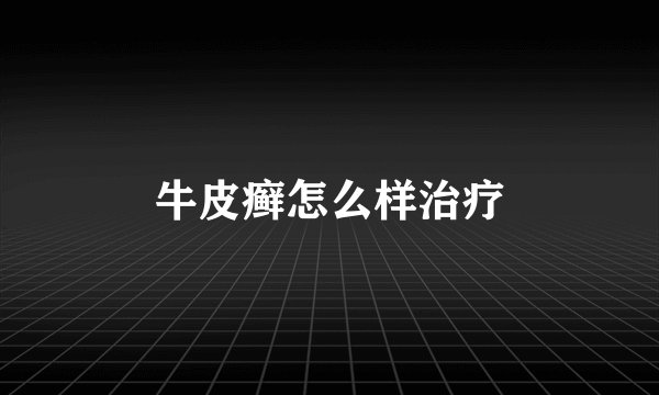 牛皮癣怎么样治疗