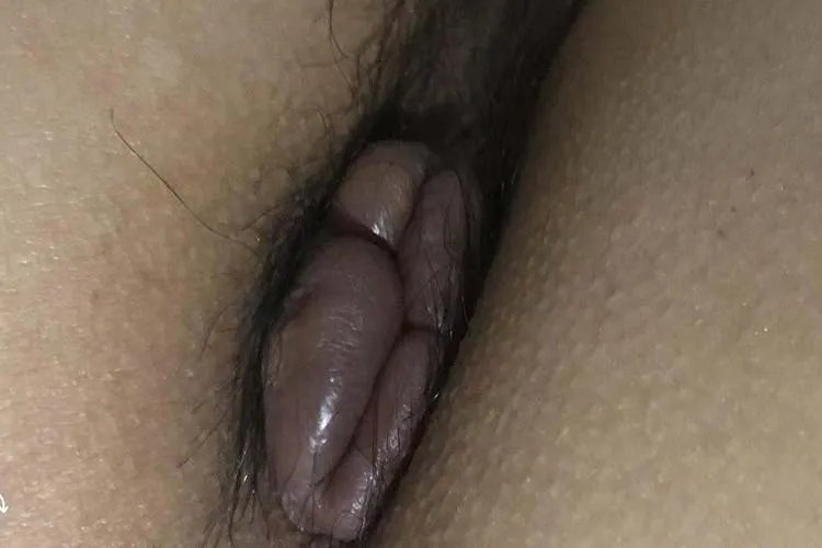四种外痔图片