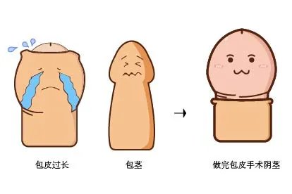 包皮过长图片