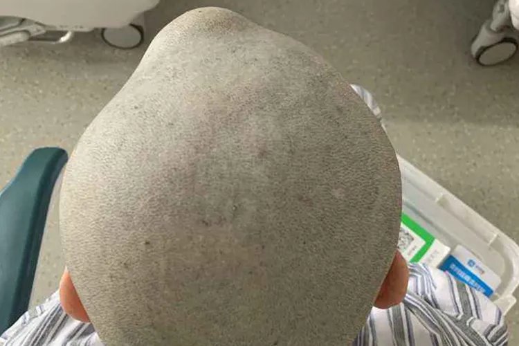 颅骨突出图片