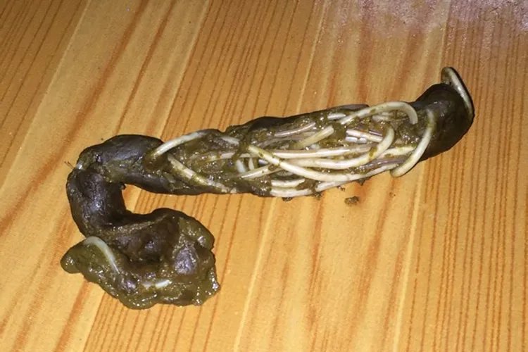 儿童蛔虫图片