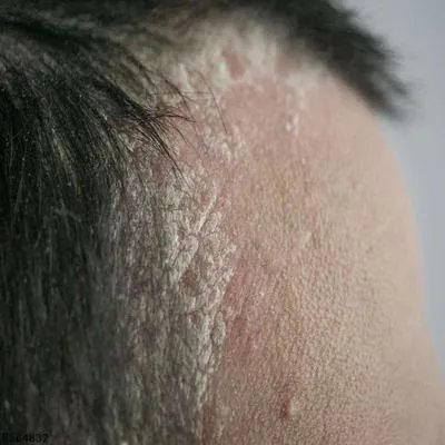 脂溢性脱发食疗方法有哪些 分享6大食疗方帮你改善脱发