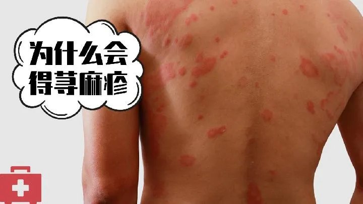 荨麻疹的病因