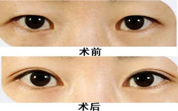 北京埋线双眼皮整形哪个医院好?