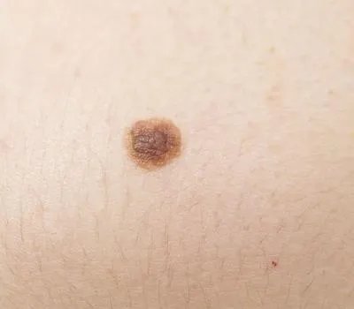 蜘蛛痣如何治疗 治疗蜘蛛痣三个方法常用