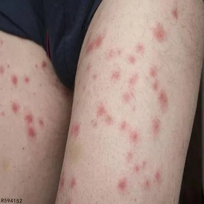 扁平苔藓有什么症状