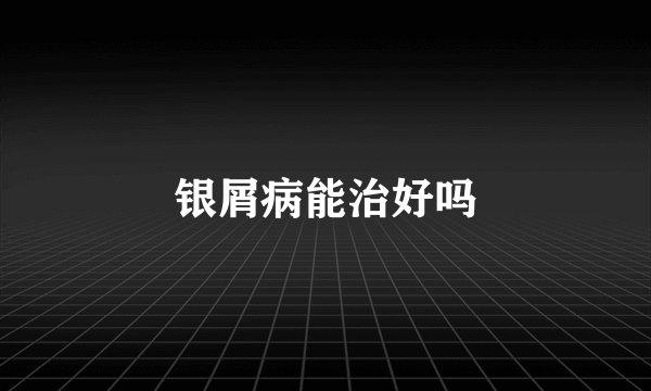 银屑病能治好吗
