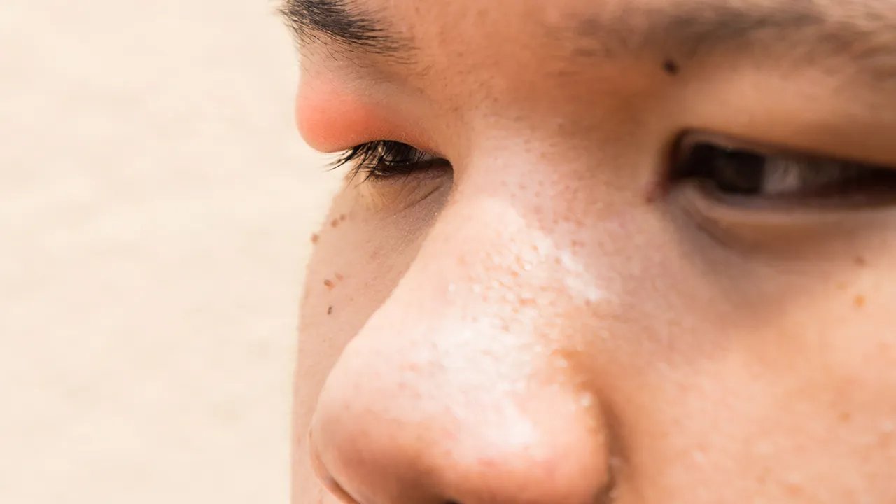 红眼病的治疗方法