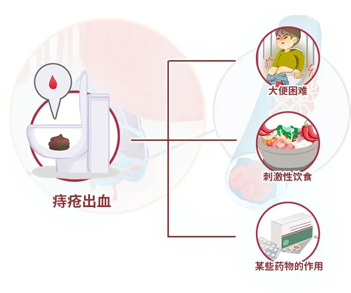 痔疮出血
