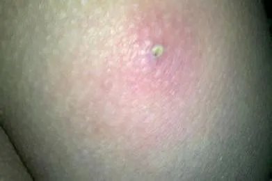 疖子的图片