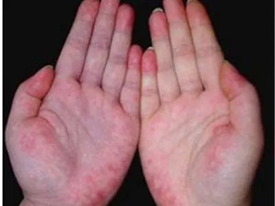 系统性红斑狼疮红斑图片