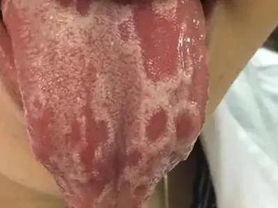 系统性红斑狼疮红斑图片
