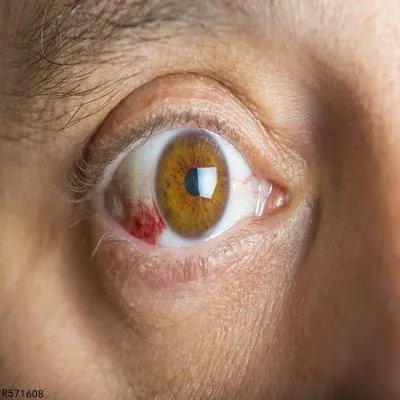 红眼病主要传播途径有哪些 了解红眼病的3个传染途径