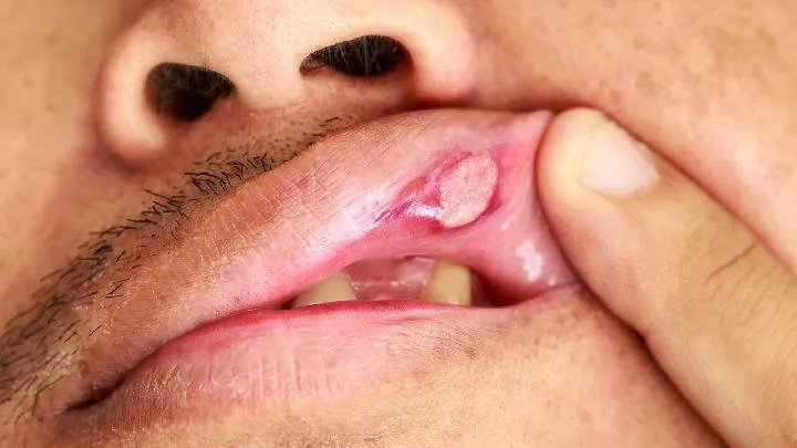 口腔溃疡吃什么好的快?口腔溃疡就吃这些食物
