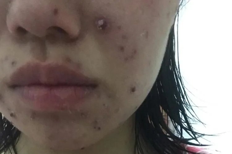起水痘是什么样的图片