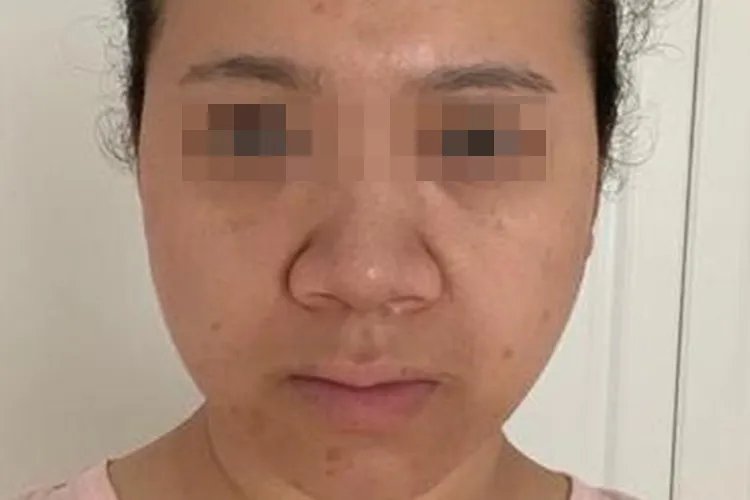 蒜头鼻长什么样