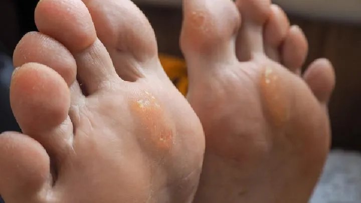 哪里治鸡眼比较好