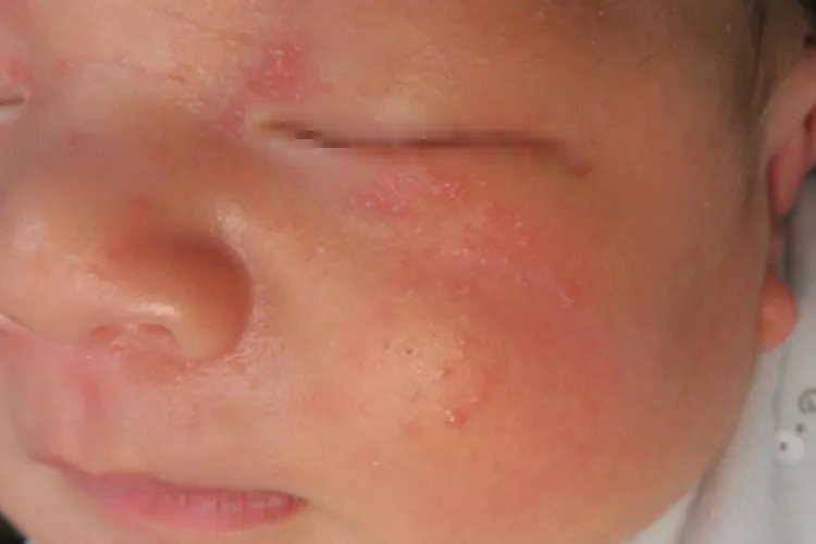 新生儿湿疹是什么样子图片