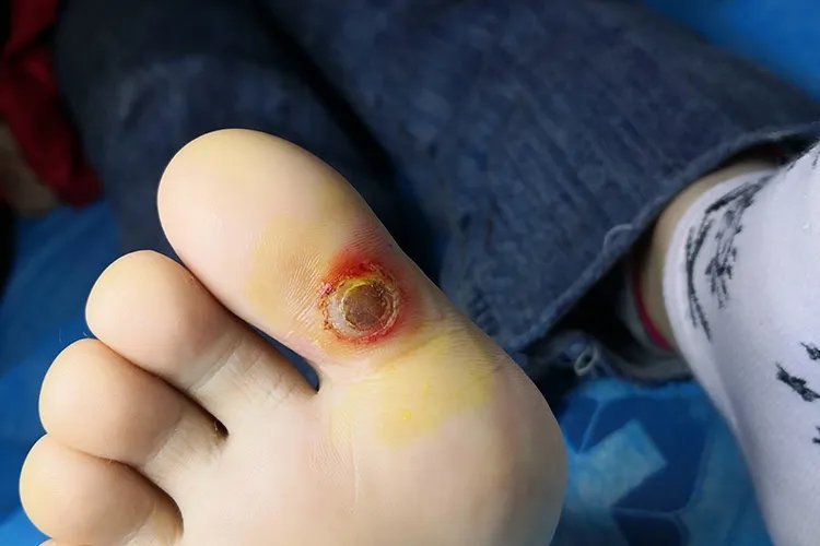 鸡眼图片
