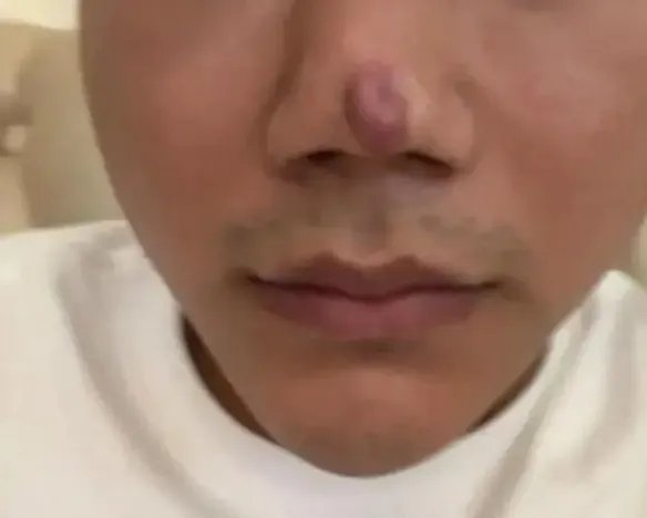 男子整形后称没法靠颜值吃饭了 隆鼻后留疤颜值下降