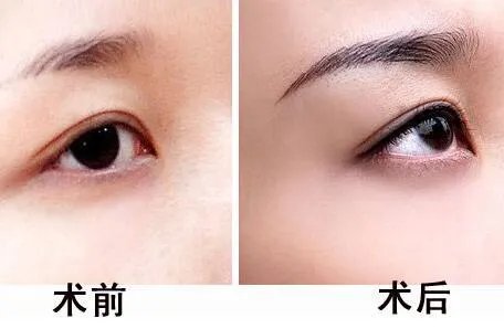 提眉手术注意事项是什么？