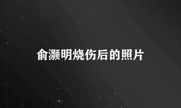 俞灏明烧伤后的照片
