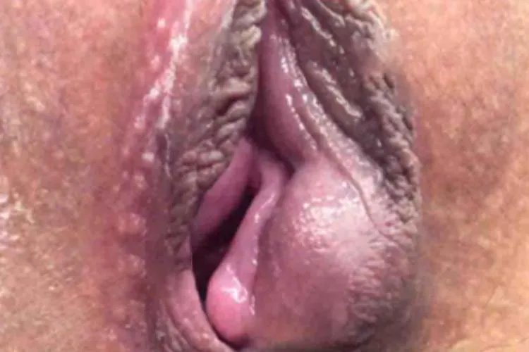 女性前庭大腺囊肿图片