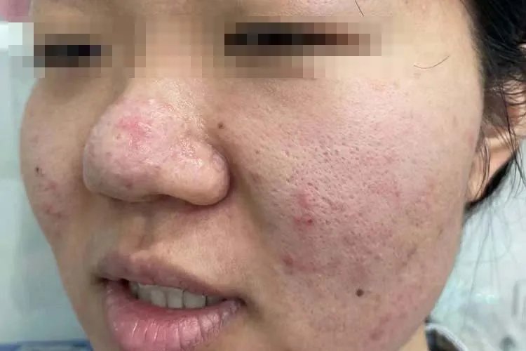 青春痘脸图片