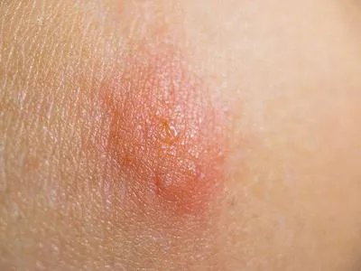 被跳蚤咬了该怎么办