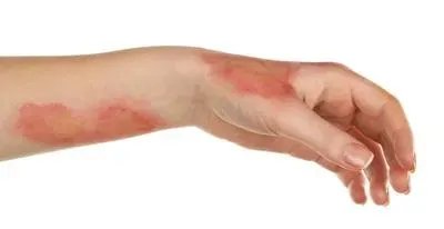 烫伤如何处理好的快 5个方法让烫伤伤口恢复更快