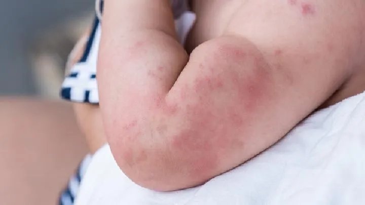 荨麻疹的病因