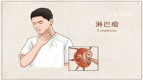 淋巴肿瘤能活多少年
