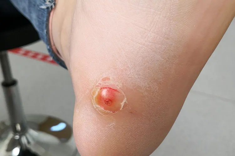 鸡眼图片